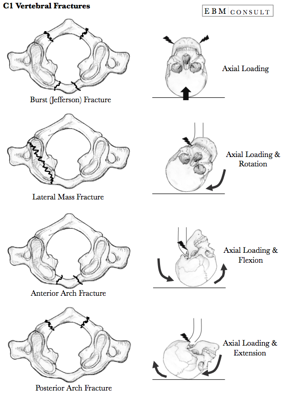 C1 Vertebral Jeffersions Fracture