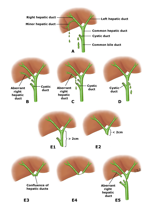 Classification_biliary_inju