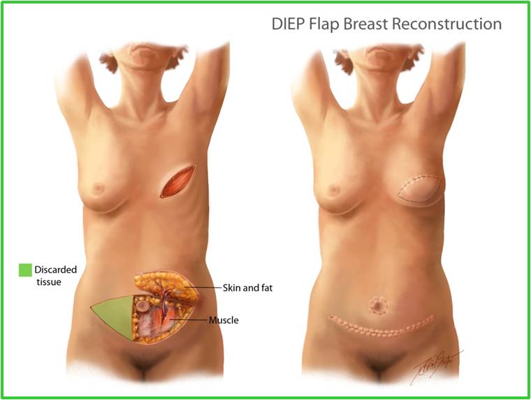 DIEP Flap