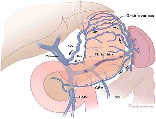 Splenic-vein-thrombosis-causing-left-sided-portal-hypertension-Note-the-gastric-varices.png