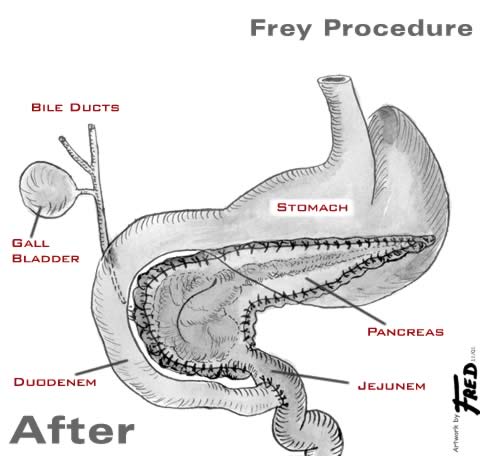 frey-after