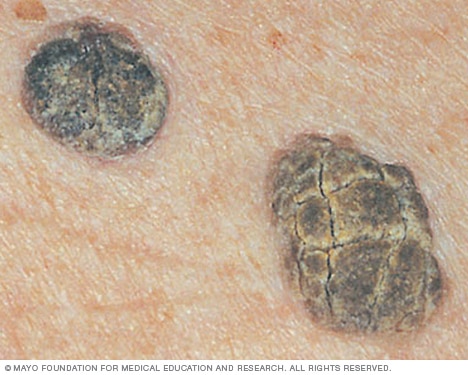 sn7_seborrheickeratosis3thu_jpg