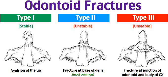 typeiii-trauma-types-orthopedics-odontoid-original